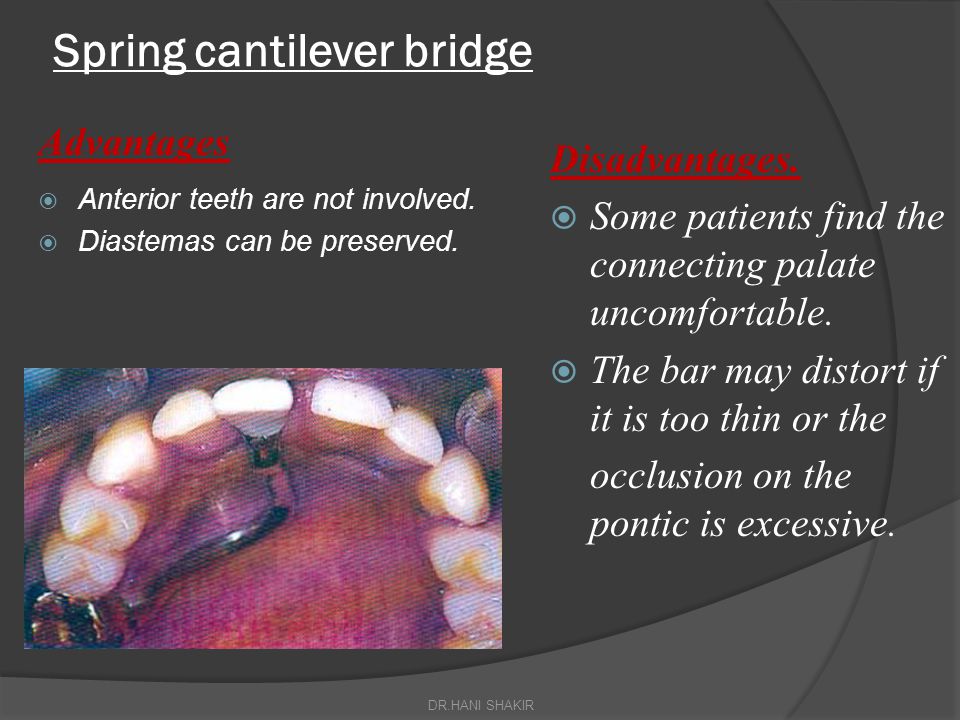 Spring Cantilever Bridge Dental